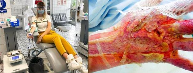 Koszmarne poparzenie 16-letniego Michała w przydomowym garażu w Zamościu! Maja Rutkowski apeluje o natychmiastowe oddawanie krwi 0 RH+ !!!